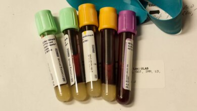 Scientists develop blood test that reveals how fast your organs are aging