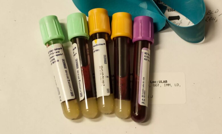 Scientists develop blood test that reveals how fast your organs are aging