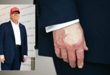 As Health Questions Swirl, Weird Spot Appears on Trump’s Hand