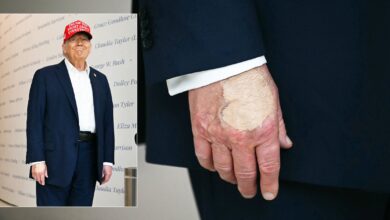 As Health Questions Swirl, Weird Spot Appears on Trump’s Hand