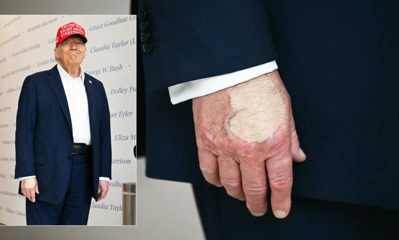 As Health Questions Swirl, Weird Spot Appears on Trump’s Hand